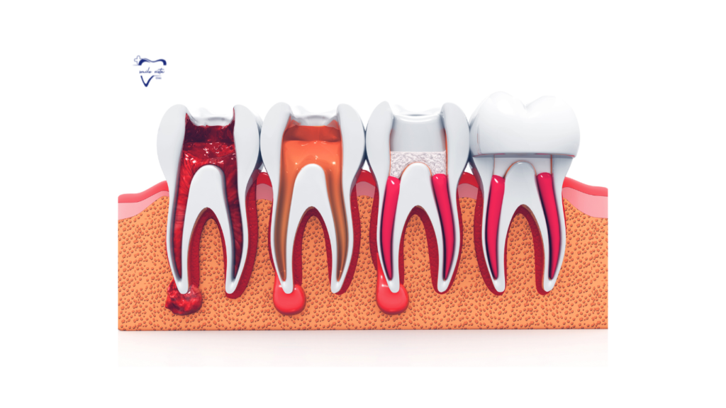 This image describe about the Root canal.