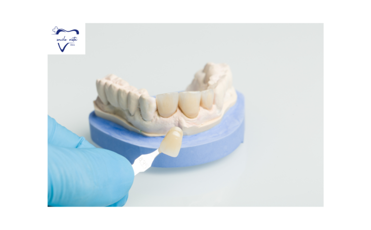 This image describe about the Dental crown.