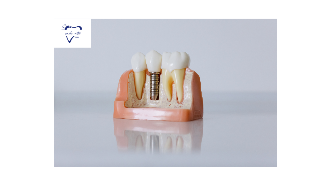 This image describe about the Dental implant.